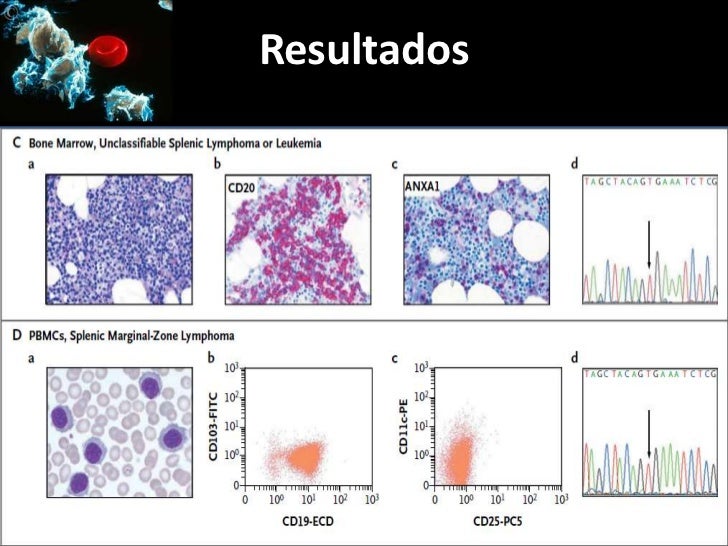 Braf mutations in Hairy Cell Leukemia