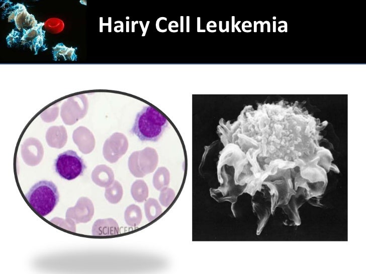 Braf mutations in Hairy Cell Leukemia