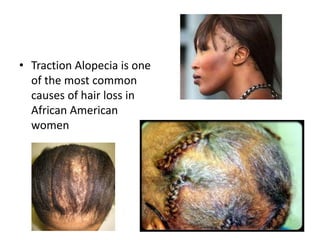 • Traction Alopecia is one
of the most common
causes of hair loss in
African American
women
 