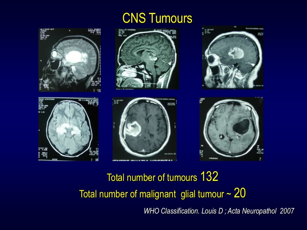 Radiosurgery in brain tumours