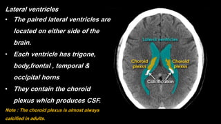 Lateral ventricles
• The paired lateral ventricles are
located on either side of the
brain.
• Each ventricle has trigone,
body,frontal , temporal &
occipital horns
• They contain the choroid
plexus which produces CSF.
Note : The choroid plexus is almost always
calcified in adults.
 