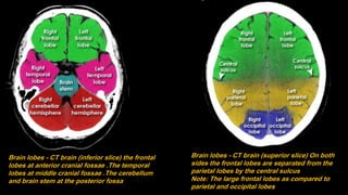 Brain lobes - CT brain (superior slice) On both
sides the frontal lobes are separated from the
parietal lobes by the central sulcus
Note: The large frontal lobes as compared to
parietal and occipital lobes
Brain lobes - CT brain (inferior slice) the frontal
lobes at anterior cranial fossae .The temporal
lobes at middle cranial fossae .The cerebellum
and brain stem at the posterior fossa
 