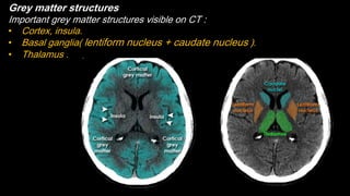 Grey matter structures
Important grey matter structures visible on CT :
• Cortex, insula.
• Basal ganglia( lentiform nucleus + caudate nucleus ).
• Thalamus .
 