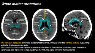 White matter structures
The internal capsules are white matter tracts which connect with the corona radiata superiorly
with the brain stem inferiorly.
The corpus callosum is a white matter tract located in the midline. It arches over the lateral
ventricles and connects white matter of the left and right cerebral hemispheres.
 