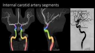 Internal carotid artery segments
 