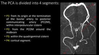 The PCA is divided into 4 segments:
• P1: from its origin at the termination
of the basilar artery to posterior
communicating artery (PCOM),
within interpeduncular cistern
• P2: from the PCOM around the
midbrain
• P3: within the quadrigeminal cistern
• P4: cortical segment.
 