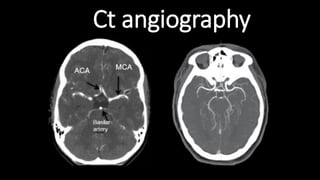 Ct angiography
 
