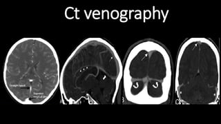 Ct venography
 