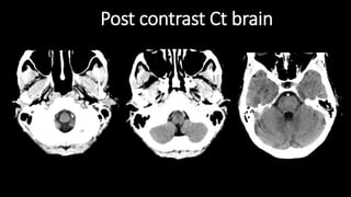 Post contrast Ct brain
 
