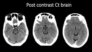 Post contrast Ct brain
 