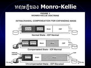 ทฤษฎีของ  Monro-Kellie 