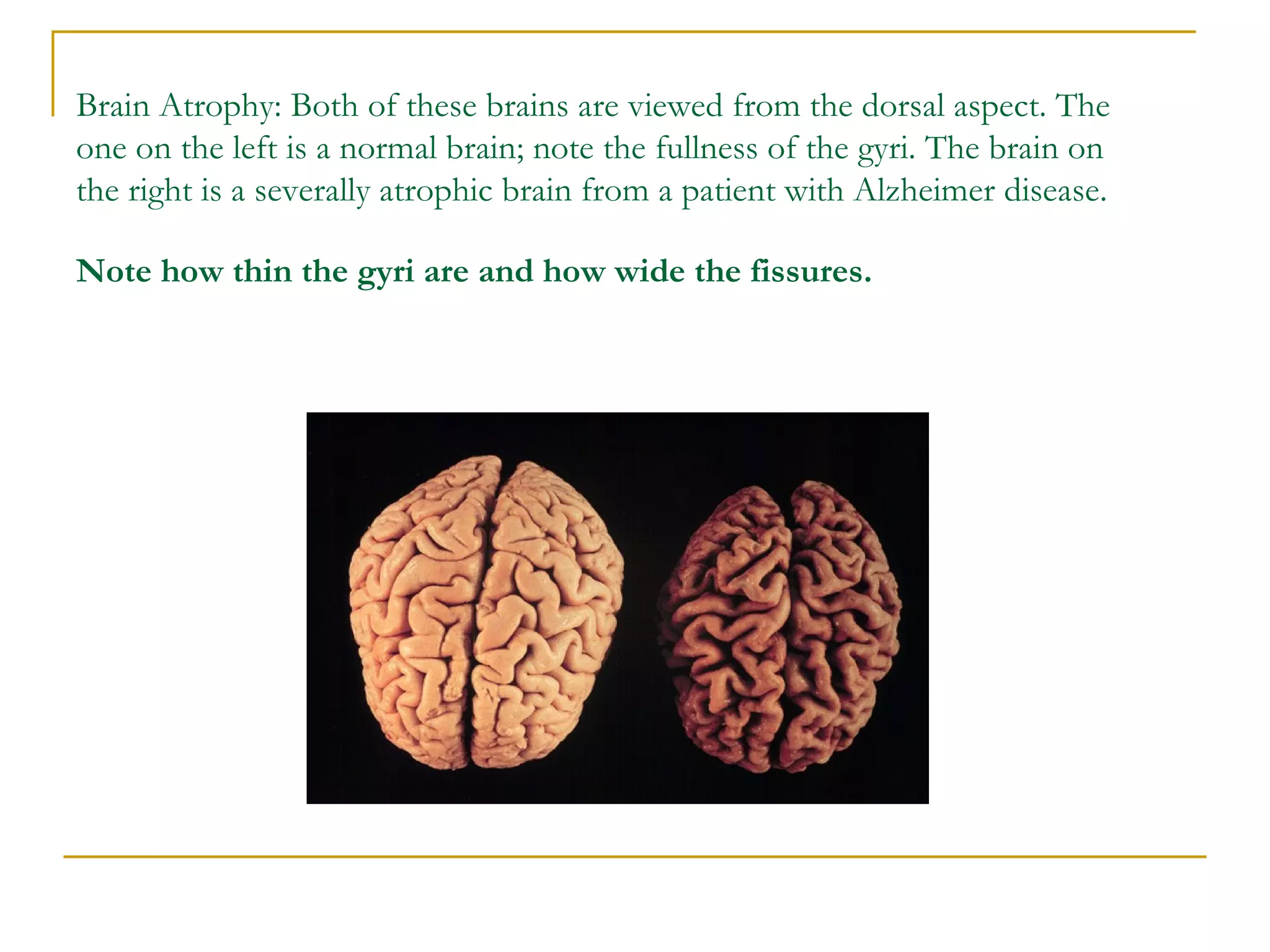 Brain Atrophy: Both of these brains are viewed from the dorsal aspect. The one on the left is a normal brain; note the fullness of the gyri. The brain on the right is a severally atrophic brain from a patient with Alzheimer disease.  Note how thin the gyri are and how wide the fissures.   