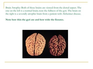 Brain Atrophy: Both of these brains are viewed from the dorsal aspect. The one on the left is a normal brain; note the fullness of the gyri. The brain on the right is a severally atrophic brain from a patient with Alzheimer disease.  Note how thin the gyri are and how wide the fissures.   