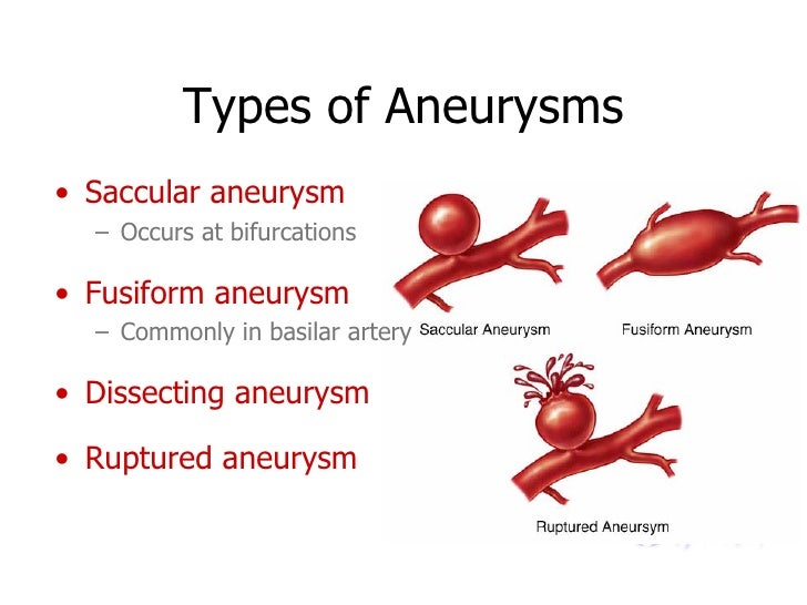 Brain Aneurysms & AV Malformations
