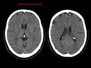 Brain-ct-lecture-new-brain ct imaging.pdf
