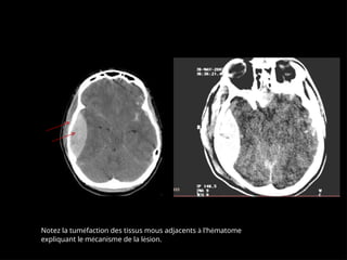 Notez la tuméfaction des tissus mous adjacents à l'hématome
expliquant le mécanisme de la lésion.
 