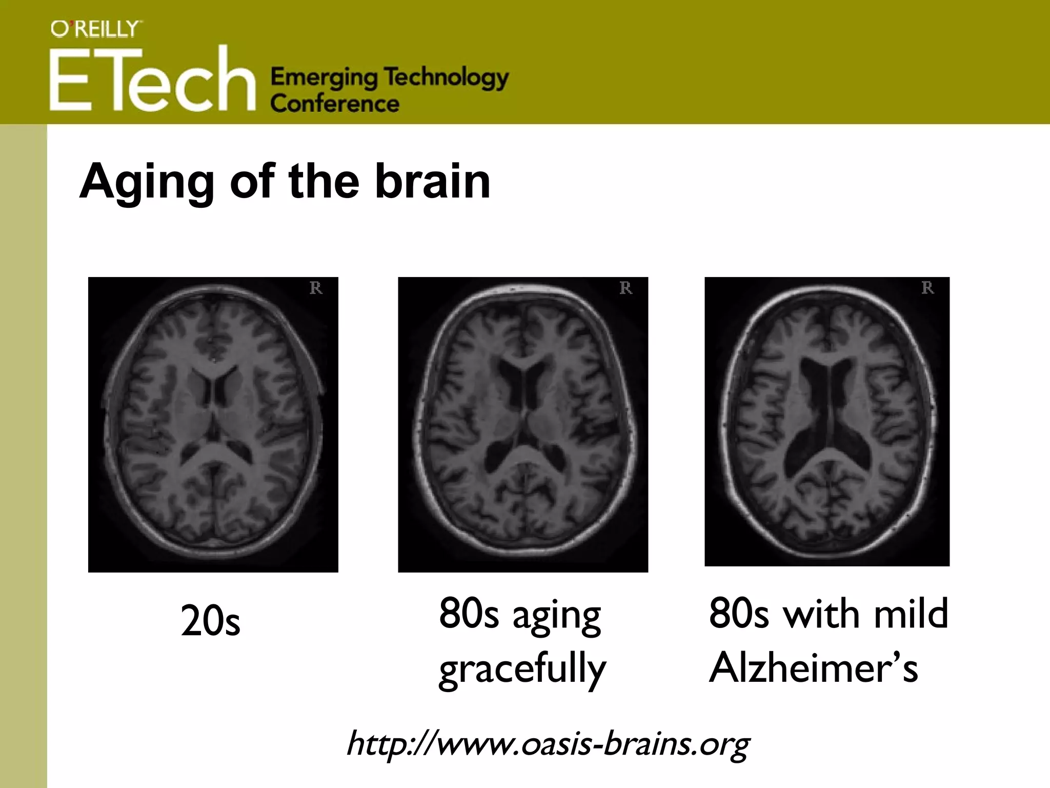 Aging of the brain 20s 80s with mild Alzheimer’s 80s aging  gracefully http://www.oasis-brains.org 