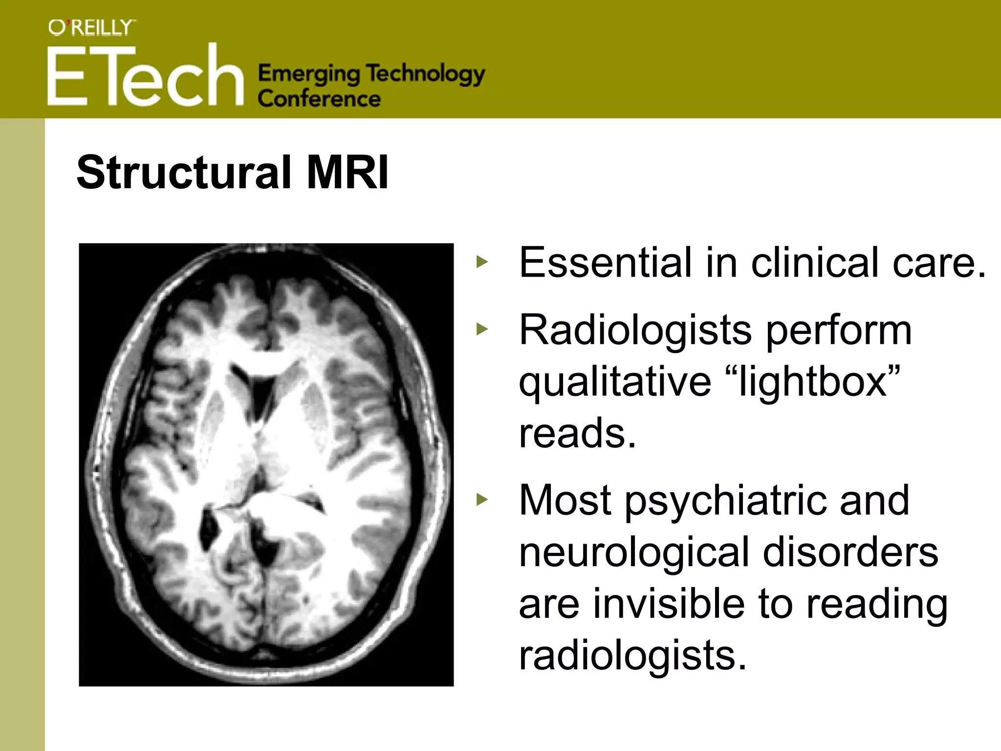 Structural MRI Essential in clinical care. Radiologists perform qualitative “lightbox” reads.  Most psychiatric and neurological disorders are invisible to reading radiologists. 