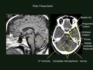 Level Ambean Normal brain imaging in CT and MRI for medical students | PDF