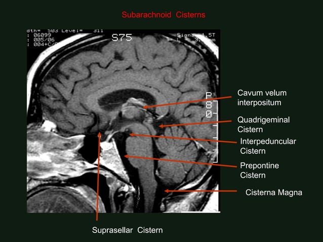 Normal brain imaging in CT and MRI for medical students | PDF | Brain ...