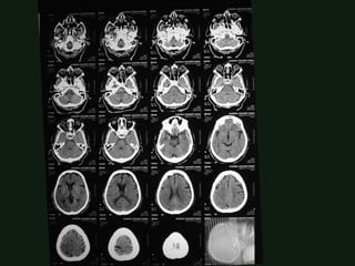 Normal brain imaging in CT and MRI for medical students | PDF