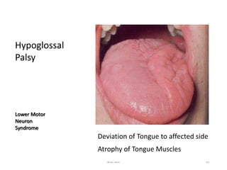 Hypoglossal
Palsy
Lower Motor
Neuron
Syndrome
Deviation of Tongue to affected side
Atrophy of Tongue Muscles
Brain stem 63
 