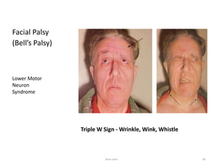 Facial Palsy
(Bell’s Palsy)
Lower Motor
Neuron
Syndrome
Triple W Sign - Wrinkle, Wink, Whistle
Brain stem 84
 