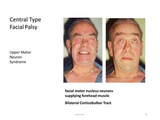 Central Type
FacialPalsy
Upper Motor
Neuron
Syndrome
facial motor nucleus neurons
supplying forehead muscle
Bilateral Corticobulbar Tract
Brain stem 86
 