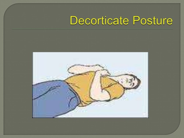 Decorticate Vs Decerebrate Posturing Medical Surgical Nursing Surgical Nursing Nursing Mnemonics