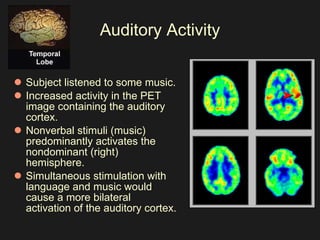 Auditory Activity Subject listened to some music.  Increased activity in the PET image containing the auditory cortex.  Nonverbal stimuli (music) predominantly activates the nondominant (right) hemisphere. Simultaneous stimulation with language and music would cause a more bilateral activation of the auditory cortex.  