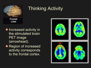 Thinking Activity Increased activity in the stimulated brain PET image (arrowhead).  Region of increased activity corresponds to the frontal cortex.  