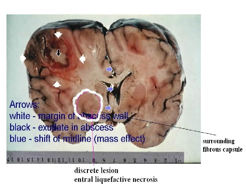 Brain abscess