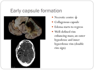 Brain abscess | PPSX