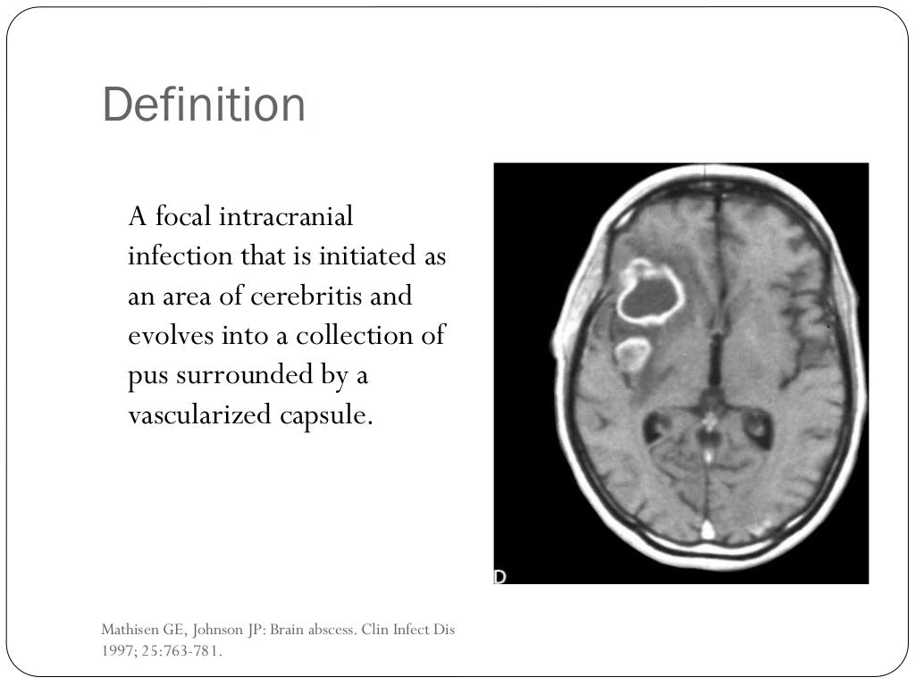 Brain abscess