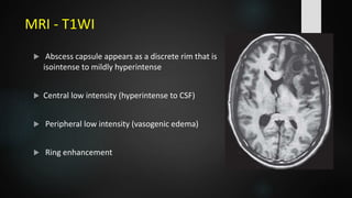 MRI - T1WI
 Abscess capsule appears as a discrete rim that is
isointense to mildly hyperintense
 Central low intensity (hyperintense to CSF)
 Peripheral low intensity (vasogenic edema)
 Ring enhancement
 
