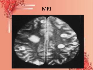 MRI
 