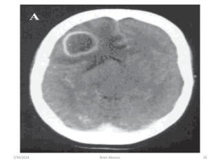 7/30/2024 Brain Abscess 20
 