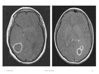 7/30/2024 Brain Abscess 21
 