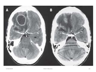 7/30/2024 Brain Abscess 22
 