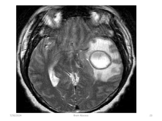 7/30/2024 Brain Abscess 23
 