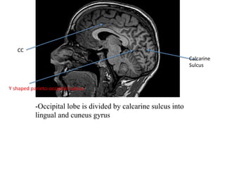 CC	
Calcarine		
Sulcus	
Y	shaped	parieto-occipital	sulcus	
-Occipital lobe is divided by calcarine sulcus into
lingual and cuneus gyrus
 