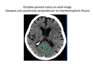 Occipito-parietal	sulcus	on	axial	image	
-Deepest	sulci	posteriorly	perpendicular	to	interhemispheric	ﬁssure	
 