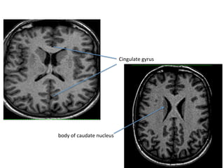 Cingulate	gyrus	
body	of	caudate	nucleus	
 
