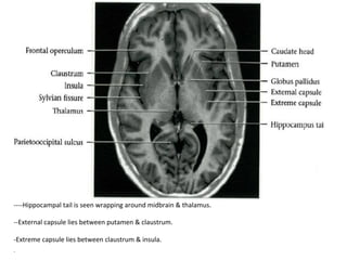 ----Hippocampal	tail	is	seen	wrapping	around	midbrain	&	thalamus.		
	
--External	capsule	lies	between	putamen	&	claustrum.		
	
-Extreme	capsule	lies	between	claustrum	&	insula.	
-
 