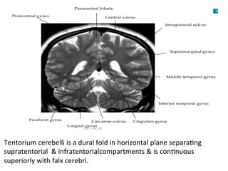 Tentorium	cerebelli	is	a	dural	fold	in	horizontal	plane	separaHng	
supratentorial		&	infratentorialcompartments	&	is	conHnuous	
superiorly	with	falx	cerebri.	
 