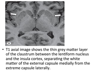 •  T1	axial	image	shows	the	thin	grey	maTer	layer	
of	the	claustrum	between	the	lenHform	nucleus	
and	the	insula	cortex,	separaHng	the	white	
maTer	of	the	external	capsule	medially	from	the	
extreme	capsule	laterally.	
 