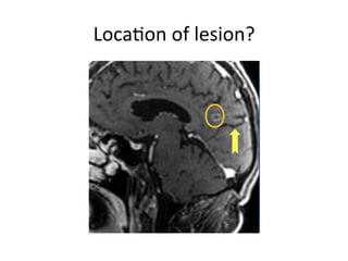 LocaHon	of	lesion?	
 