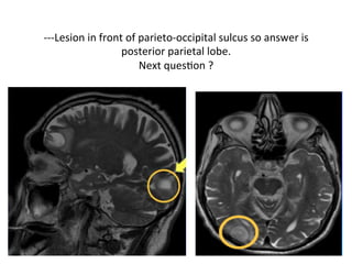 ---Lesion	in	front	of	parieto-occipital	sulcus	so	answer	is	
posterior	parietal	lobe.	
Next	quesHon	?	
 