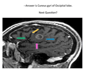 --Answer	is	Cuneus	gyri	of	Occipital	lobe.	
	
Next	QuesHon?	
 