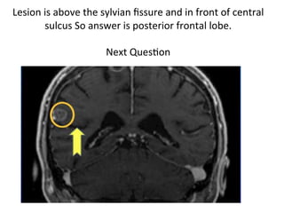 Lesion	is	above	the	sylvian	ﬁssure	and	in	front	of	central	
sulcus	So	answer	is	posterior	frontal	lobe.	
	
Next	QuesHon	
	
 